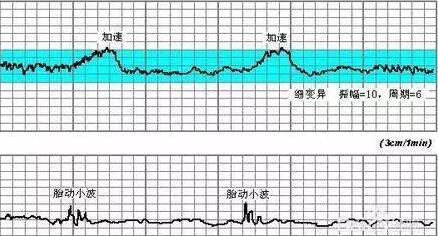 入门版解析，胎心监护图与胎动次数观察详解，持久性执行策略_经典款37.48.49